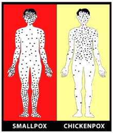 Smallpox | Smallpox 2002