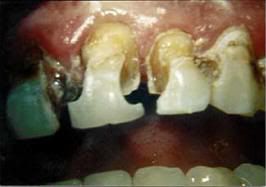Overcoming Toothache
